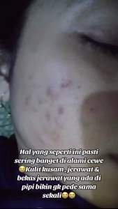 [BONUS CLUTH KOSMETIK]ORLIN BEAUTY PAKET ACNE HEMAT PAKET HEMAT PENGHILANG JERAWAT PAKET BEBAS JERAWAT KRIM BPOM AMPUH ATASI BERUNTUSAN ORLIN SKINCARE JERAWAT ORLN KRIM JERAWAT PAKET SKINCARE WAJAH SENSITIF SKINCARE JERAWAT BEKASNYA SKINCARE JERAWAT BATUI