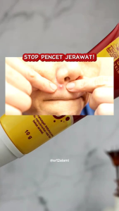 ACNE TOTOL SR12 OBAT JERAWAT AMPUH