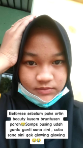 ECER cream anti jerawat/acne series orlin beauty