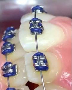 SIKAT SELA BEHEL GIGI PREMIUM DENGAN TUTUP - INTERDENTAL BRUSH ORTHO DR SMITH DENTAL FLOSS BEHEL DENTAL - Sikat Pembersih Sela Celah Gusi Dan Gigi - Tusuk Orthodontics