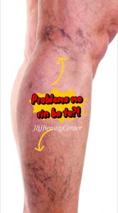 Buy2Take1 Varicose Veins Cream