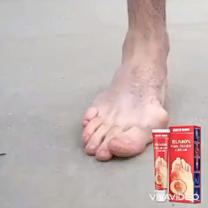 SOUTHMOON BUNION PAIN RELIEF CREAM Krim rawatan tulang bunion betulkan tulang bengkok legakan sakit tulan sendi badan