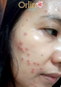 ACNE GLOWING Orlin Skincare BPOM Merawat Wajah Kulit Sensitif Berjerawat / Bopeng Jerawat Bandel Meradang