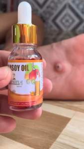15ml Kasoy Oil for Mole All kinds of Warts Skintags Eczema