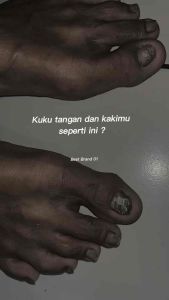 TERLARIS!! Repair Serum Penumbuh Kuku Penghilang Jamur Kuku & Centengan AMPUH 100% ORIGINAL