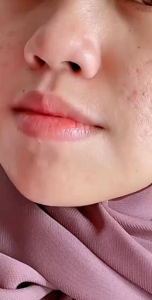 Special Package Noera Lipcare Set | Noera Lip Serum Noera Lip Balm Noera Lip Scrub
