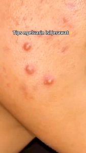 Noera Acne Patches - Acne Patch