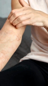 HAEMAGEN ® Haemagen Original 60 Kapsul Bersih Darah | Haemagen Atasi Gatal Eksim Alergi & Jerawat