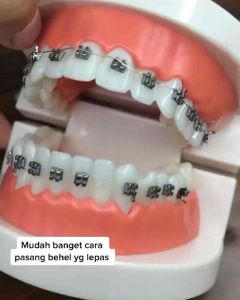LEM BEHEL BRACKET ORTHO FORCE MINI NON TANPA LASER NOMIX ORTHOFORCE ORTHODONTIC NO MIX