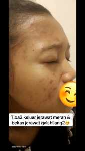 PAKET ACNE GLOWING/PAKET ACNE/ORLIN BEAUTY/BPOM/PAKET JERAWAT