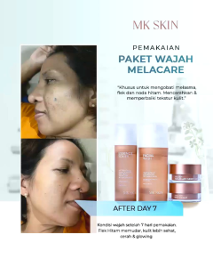 MK SKIN Melacare Series - Flek hitam Treatment