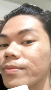 LAYNA PAKET ACNE WHITE GLOW