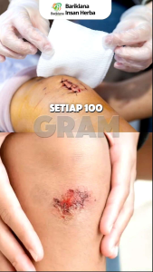 Dekabumin dari kapsul ikan gabus bariklana untuk luka pasca operasi