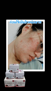 ครีมบำรุงผิวหน้า ลาพิสต้า ลาเมล่า ไบร์ท โปร พลัส สำหรับคนแพ้ง่าย สูตรสิวผิวแพ้ง่าย ลดสิวรอยสิว ฝ้า กระ จุดด่างดำ ขนาด 12 g ของแท้ 100%