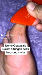 Tumitku 30ml: Solusi Obat Kaki Pecah-Pecah & Kapalan