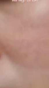 CHÍNH HÃNG Kem Phục Hồi Da Mộc Nhân Nhiễm corticoid Da Mỏng Yếu Lộ Mao Mạch Da Khô Ráp