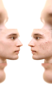 1 Set Lengkap Paket ClorisMen isi 1 Sabun 1 Acno 1 SC Serum dan 1 Soft Case // Wadah Sabun Lebih Praktis dibawa Kemanapun