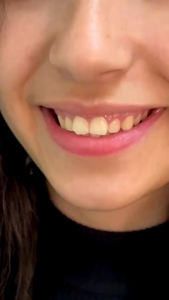 Snap On Smile Gigi Palsu 100% Authentic Satu Set (Atas & Bawah)