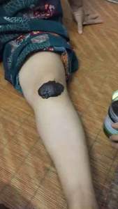 CAO ĐẮP XƯƠNG KHỚP DÂN TÔC