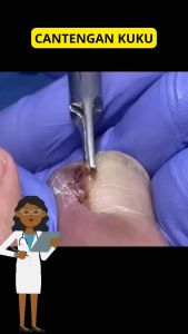 DIACOIL NAIL SERUM Obat Jamur Kuku Kaki Cantengan Penghilang Bakteri Kuku Isi 20ml