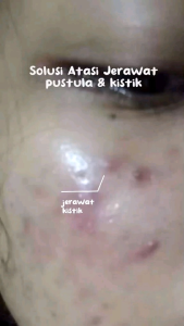 Niacinamide Acnes Spot Gel Obat Totol Jerawat Hilangkan Bekas Jerawat I Mellydia Acne Gel 15gr BPOM