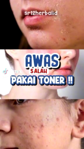 Toner BHA SR12: Solusi Toner Untuk Kulit Beruntusan & Jerawat