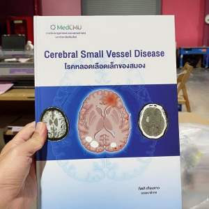 9786163989680 c111 โรคหลอดเลือดเล็กของสมอง (CEREBRAL SMALL VESSEL DISEASE)