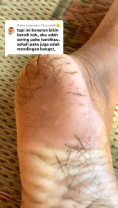 TUMITKU - Mengatasi Kaki Kapalan dan Tumit Pecah Pecah