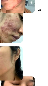 Nước sâm tái tạo da mụn rổ _Kem dưỡng phục hồi sau tái tạo Hạnh Sinoo cải thiện mọi loại da mụnnámtàn nhang