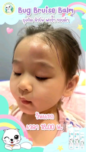 พร้อมส่ง Lynn Organic:Bug Bruise Balm บาล์มสติ๊ก ลดการอักเสบ หลังยุงและแมลงกัด ฟกช้ำ หัวโน กระแทก และชนของแข็ง