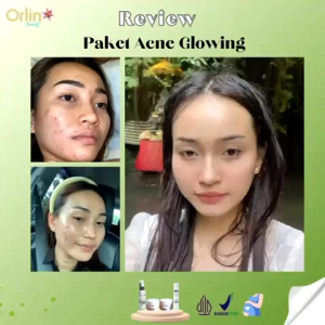 SERUM ACNE ORLIN BEAUTY SERUM JERAWAT SERUM BOPENG ORLIN BEUATY SKINCARE