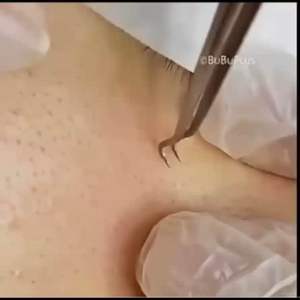 Blackhead Remover Tweezer/ Facial Pimples Remover