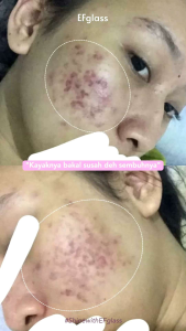 EFglass Paket Basic Acne (Tanpa Toner)
