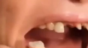 TEMPORARY BRACE SNAP ON TEETH VENEERS cantikkan senyuman dengan veneers ini menutup gigi hitam patah gigi hilang