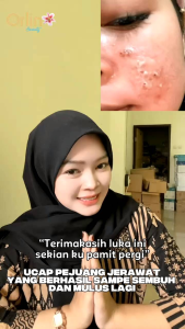 Acne hemat Orlinbeauty/jerawat meradang/jerawat bandel