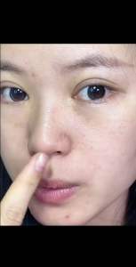 不锈钢粉刺夹4件套Stainless Steel 4-Piece Comedones Clipper Set  #很好用的细胞夹😍，可以把黑头粉刺和痘痘连根夹出来，清理皮肤的好帮手#细胞夹 #面部清洁 #解压粉刺针🌈.