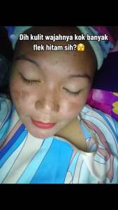 Paket Flek Platinum Orlin Beauty Skincare: Memudarkan Flek Hitam & Mencerahkan Wajah