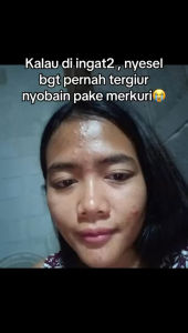 ACNE SERIES /Paket Acne glowing/paket Acne Hemat/kulit berjerawat/beruntusan/orlin beautyskincare