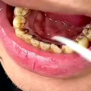 Floss Scalling ORI Pasta Gigi / Odol Pemutih Gigi dan Karang Gigi Baking Soda