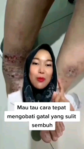 Minyak Bulus SR12 Original BPOM Wangi Melati - Menghilangkan Gatal Alergi Penyakit Kulit Eksim Panu - Mengatasi Jerawat Flek Hitam -v