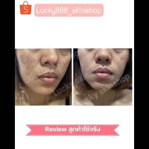 ชุดรักษาฝ้า หมอโปรดปราน