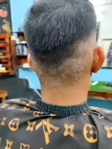 Masalah Kulit Kepala Kelemumur Dan Berkuping Anti Dandruff Treatment