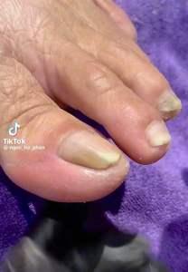 Cây lấy khoé móng cán gỗ  lấy khoé êm không đau dễ dàng lấy khoé móng sâu nhanh chóng và tiện lợi