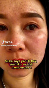 Promo Amura Gold Serum-Atasi Flek Hitam&Penuaan