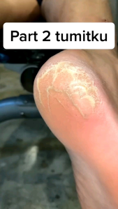 TUMITKU OBAT KAKI PECAH PECAH DAN KAPALAN Solusi kaki pecah pecah dan kapalan