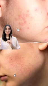 Ella Skincare Intensive Acne Cream