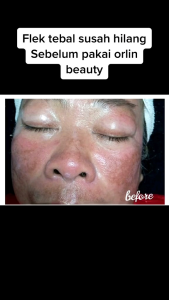 Orlin Beauty Skincare Paket Flek Platinum + Serum Anti Aging / Krim Flek Tebal Menahun /bpom (free duoble gift cantik)