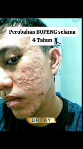 PROMO 2 BOTOL Dr Fay - Krim Penghilang Bekas Jerawat Dan Flek Hitam Original RESMI