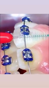 Brush Behel Ortho | Sikat Untuk sela Behel | Brush Sela Gigi
