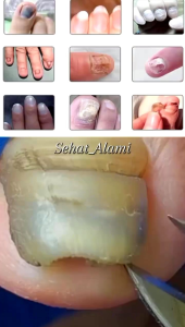 DIACOIL NAIL SERUM ORIGINAL | OBAT  JAMUR KUKU | CANTENGAN DAN BERNANAH | AMPUH 100%